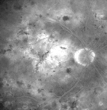 Maculopathie oedemateuse - les pages laser Copyright Dr T Desmettre / COCNet